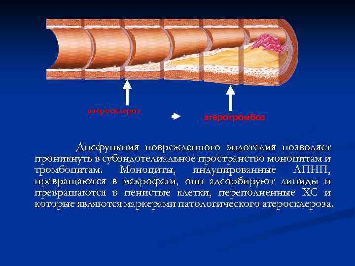 атеросклероз атеротромбоз Дисфункция поврежденного эндотелия позволяет проникнуть в субэндотелиальное пространство моноцитам и тромбоцитам. Моноциты,