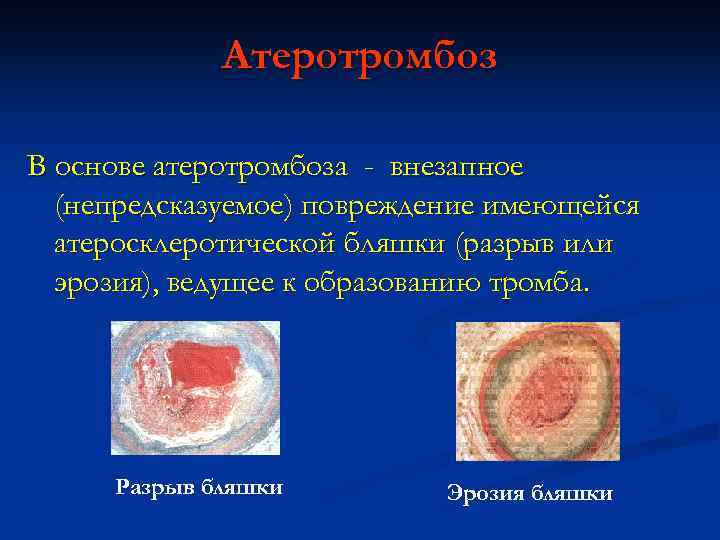 Атеротромбоз В основе атеротромбоза - внезапное (непредсказуемое) повреждение имеющейся атеросклеротической бляшки (разрыв или эрозия),