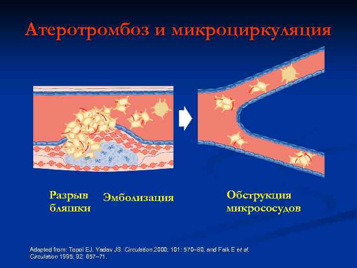 Атеротромбоз и микроциркуляция Разрыв бляшки Эмболизация Обструкция микрососудов Adapted from: Topol EJ, Yadav JS.