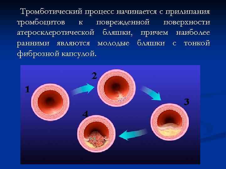 Тромботический процесс начинается с прилипания тромбоцитов к поврежденной поверхности атеросклеротической бляшки, причем наиболее ранними