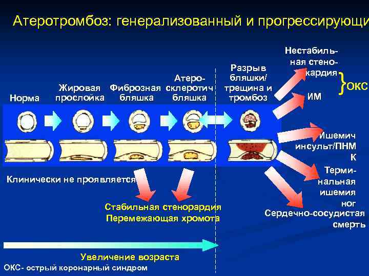 Атеротромбоз: генерализованный и прогрессирующи Норма Атеро. Жировая Фиброзная склеротич бляшка прослойка бляшка Клинически не