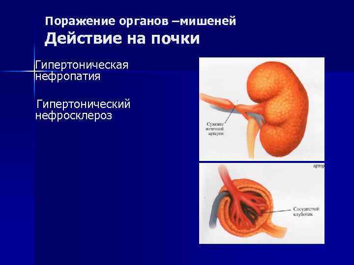 Поражение органов –мишеней Действие на почки Гипертоническая нефропатия Гипертонический нефросклероз 