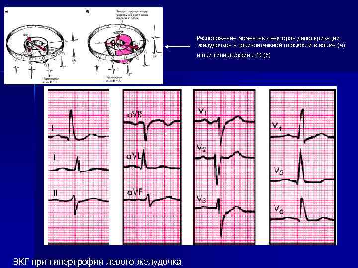 Расположение моментных векторов деполяризации желудочков в горизонтальной плоскости в норме (а) и при гипертрофии