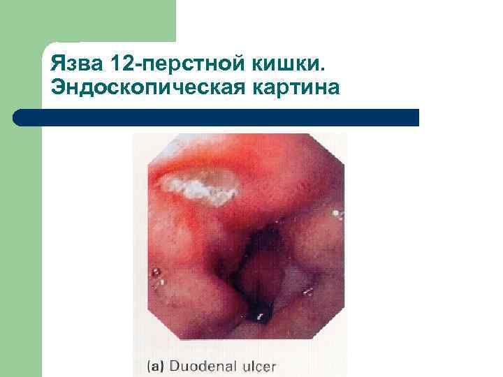 Язва 12 -перстной кишки. Эндоскопическая картина 