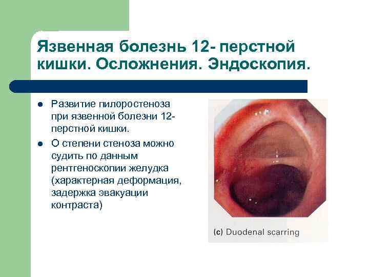 Язвенная болезнь 12 - перстной кишки. Осложнения. Эндоскопия. l l Развитие пилоростеноза при язвенной