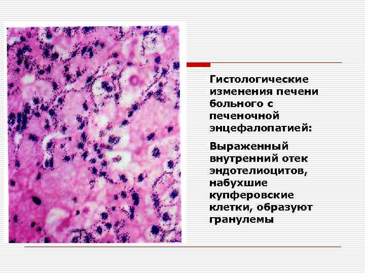 Гистологические изменения печени больного с печеночной энцефалопатией: Выраженный внутренний отек эндотелиоцитов, набухшие купферовские клетки,