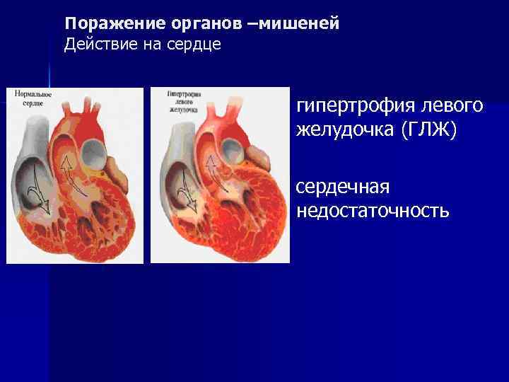 Поражение органов –мишеней Действие на сердце гипертрофия левого желудочка (ГЛЖ) сердечная недостаточность 