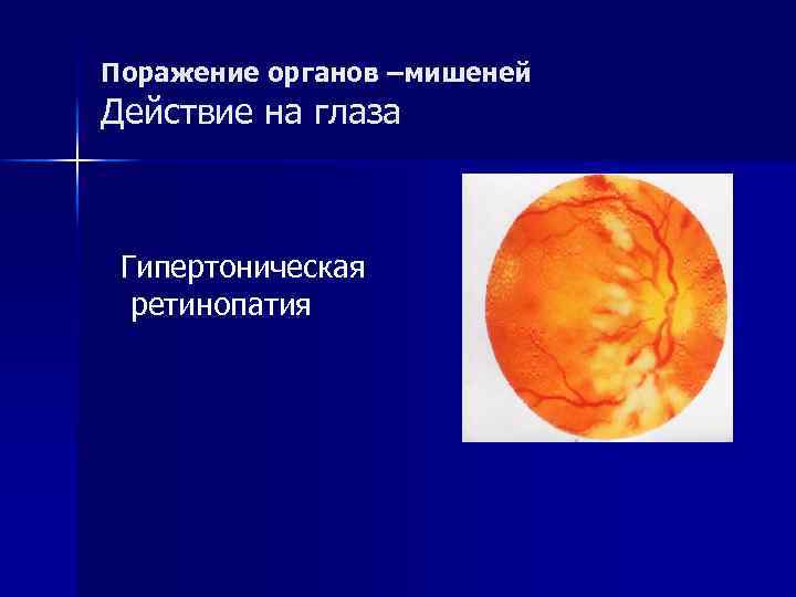 Поражение органов –мишеней Действие на глаза Гипертоническая ретинопатия 