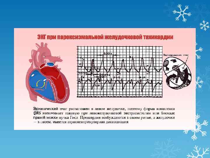 Тахикардия на экг