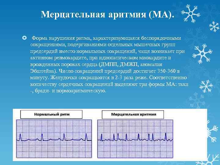 Мерцательная аритмия (МА). Форма нарушения ритма, характеризующаяся беспорядочными сокращениями, подергиваниями отдельных мышечных групп предсердий