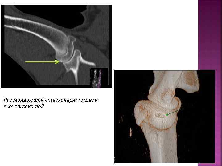Расслаивающий остеохондрит головок плечевых костей 