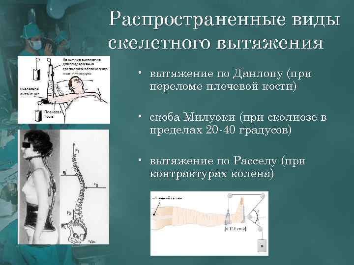 Распространенные виды скелетного вытяжения • вытяжение по Данлопу (при переломе плечевой кости) • скоба