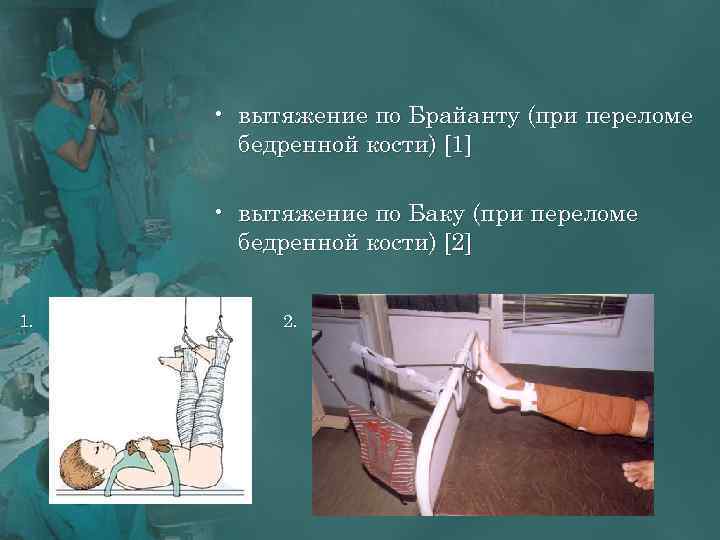  • вытяжение по Брайанту (при переломе бедренной кости) [1] • вытяжение по Баку