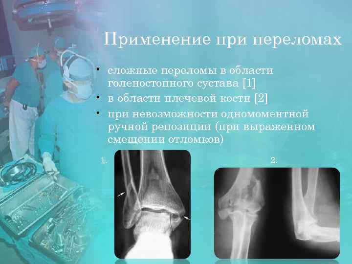 Применение при переломах • сложные переломы в области голеностопного сустава [1] • в области