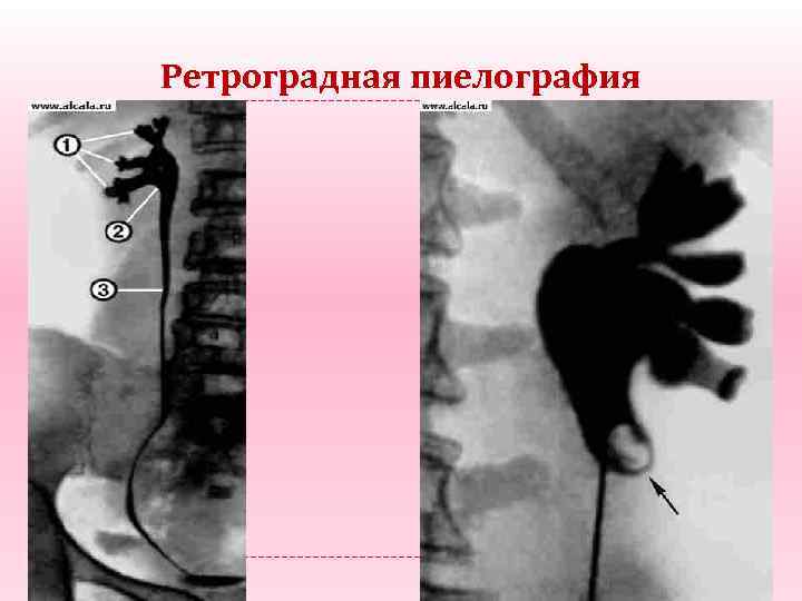 Ретроградная пиелография 