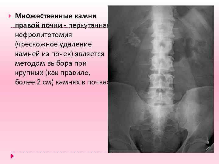  Множественные камни правой почки - перкутанная нефролитотомия (чрескожное удаление камней из почек) является