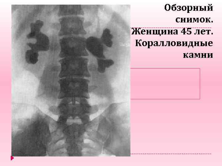 Обзорный снимок. Женщина 45 лет. Коралловидные камни 