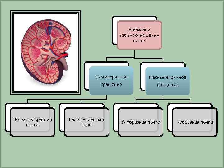 Аномалии взаимоотношения почек Симметричное сращение Подковообразная почка Несимметричное сращение Галетообразная почка S- образная почка