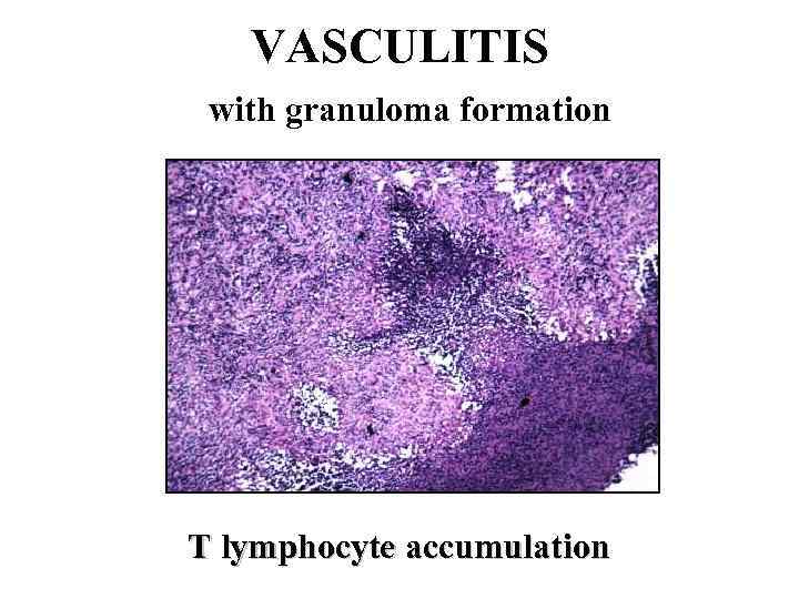 VASCULITIS with granuloma formation T lymphocyte accumulation 