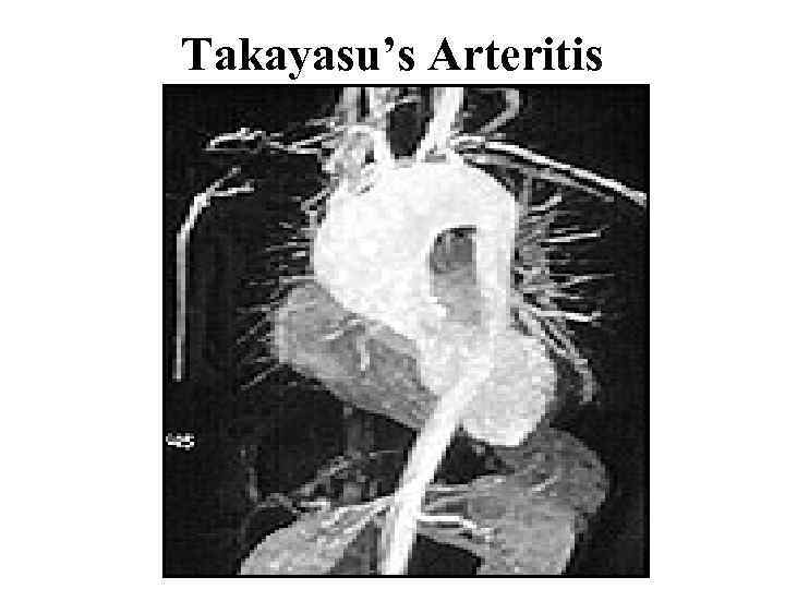 Takayasu’s Arteritis 