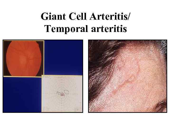 Giant Cell Arteritis/ Temporal arteritis 