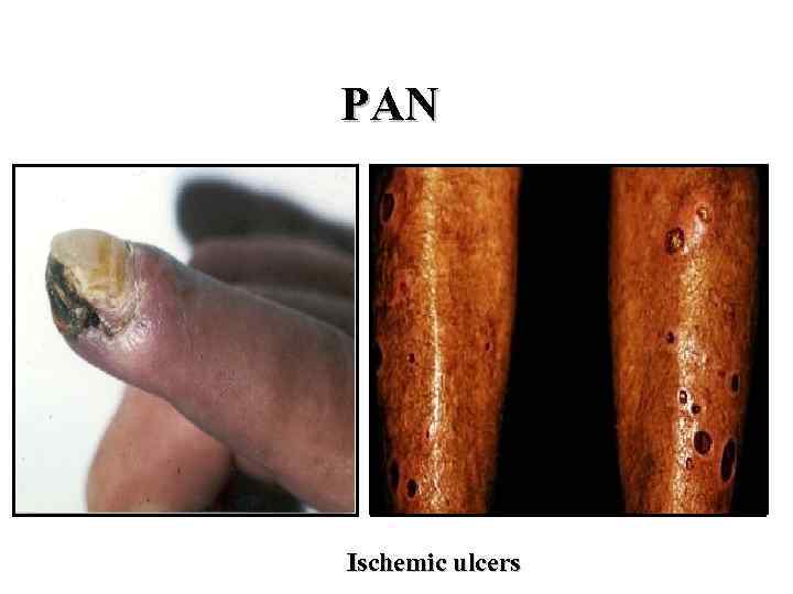 PAN Ischemic ulcers 