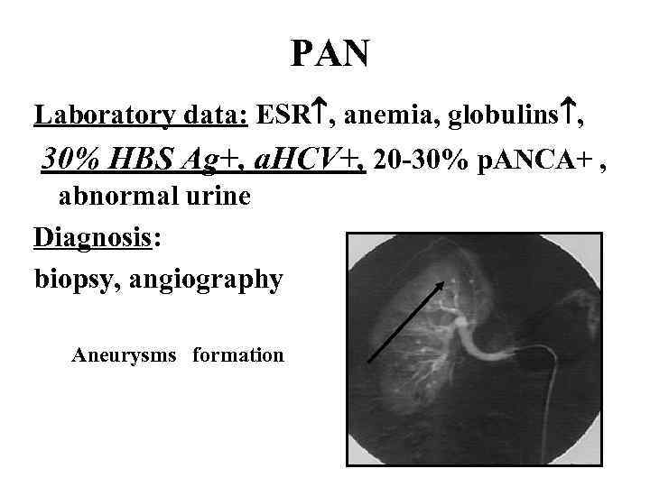 PAN Laboratory data: ESR , anemia, globulins , 30% HBS Ag+, a. HCV+, 20