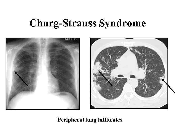 Churg-Strauss Syndrome Peripheral lung infiltrates 