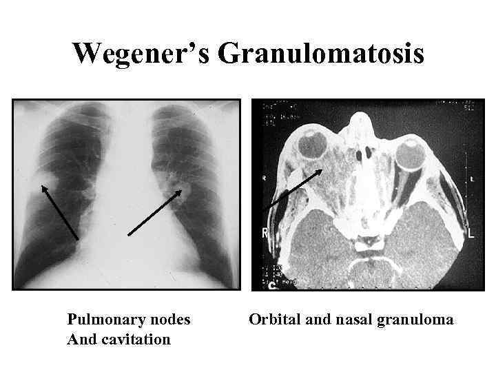 Wegener’s Granulomatosis Pulmonary nodes And cavitation Orbital and nasal granuloma 