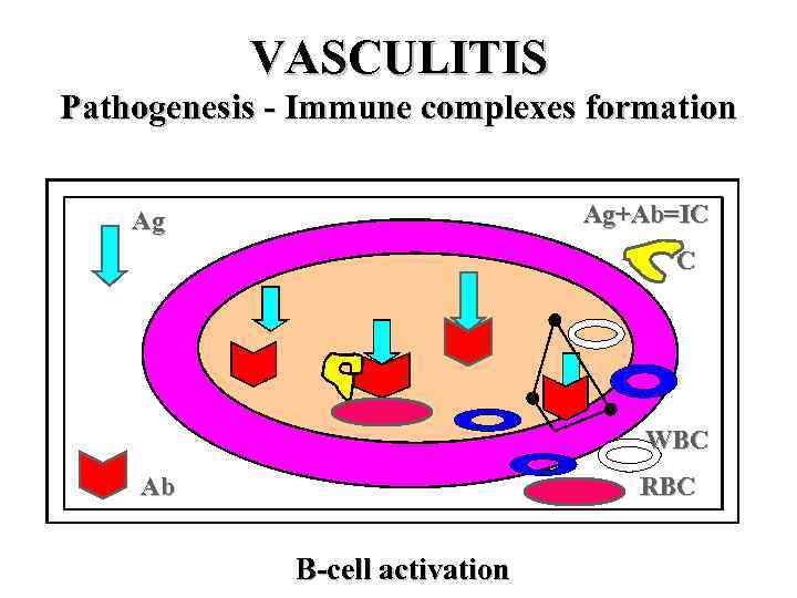 VASCULITIS Pathogenesis - Immune complexes formation Ag+Ab=IC Ag C WBC Ab RBC B-cell activation