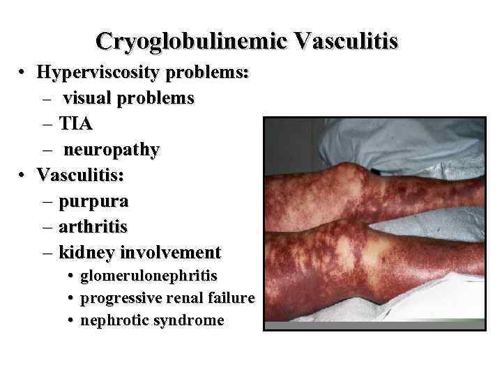 Cryoglobulinemic Vasculitis • Hyperviscosity problems: – visual problems – TIA – neuropathy • Vasculitis: