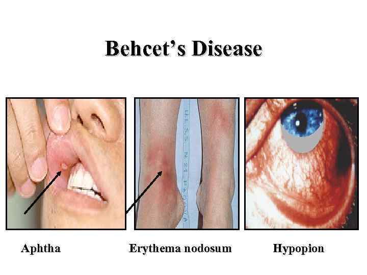 Behcet’s Disease Aphtha Erythema nodosum Hypopion 