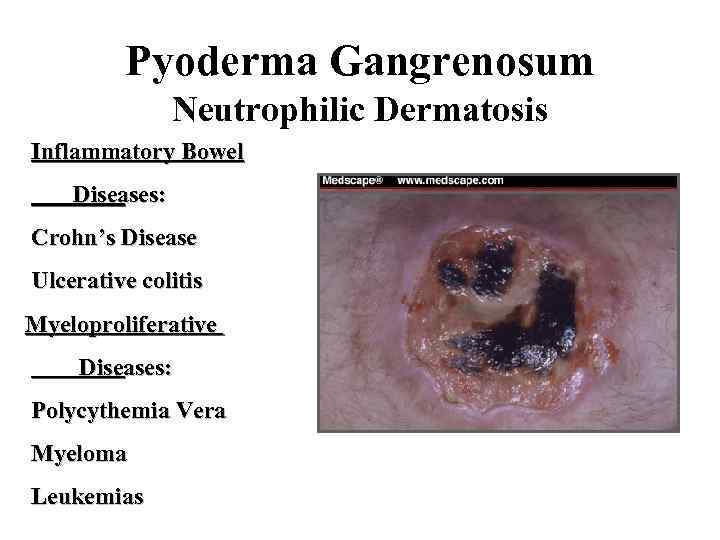 Pyoderma Gangrenosum Neutrophilic Dermatosis Inflammatory Bowel Diseases: Crohn’s Disease Ulcerative colitis Myeloproliferative Diseases: Polycythemia