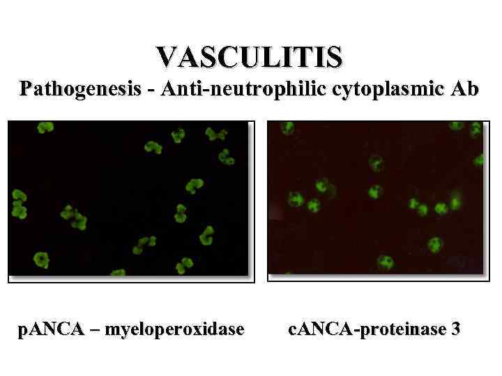 VASCULITIS Pathogenesis - Anti-neutrophilic cytoplasmic Ab p. ANCA – myeloperoxidase c. ANCA-proteinase 3 