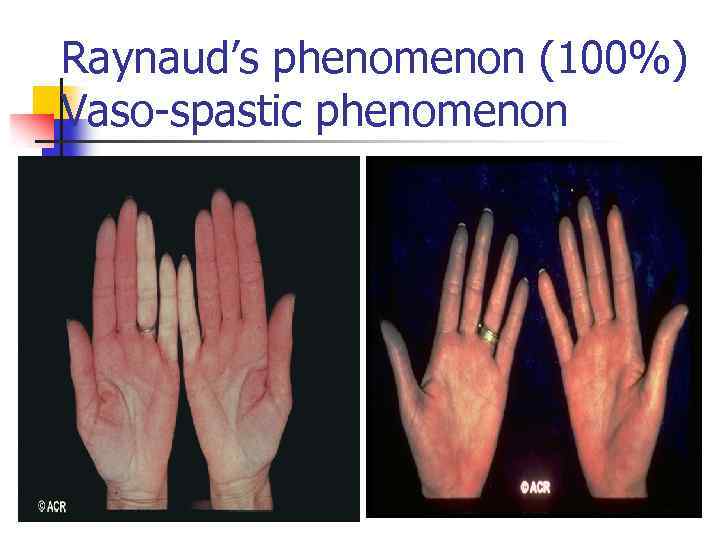 Raynaud’s phenomenon (100%) Vaso-spastic phenomenon 