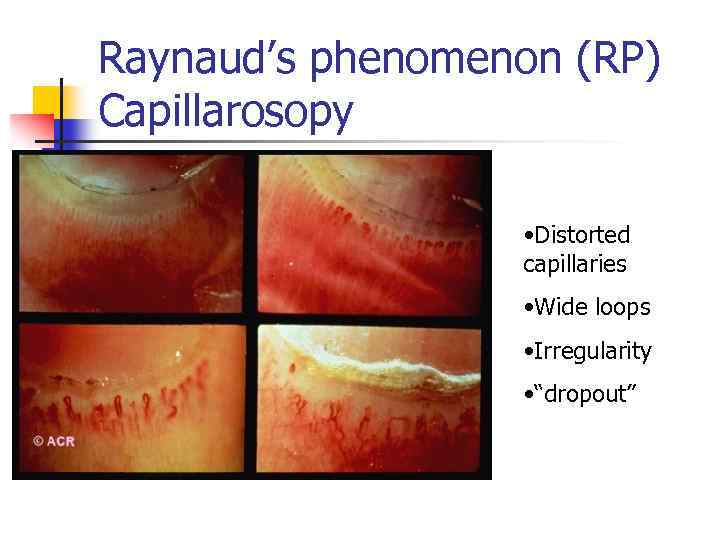 Raynaud’s phenomenon (RP) Capillarosopy • Distorted capillaries • Wide loops • Irregularity • “dropout”