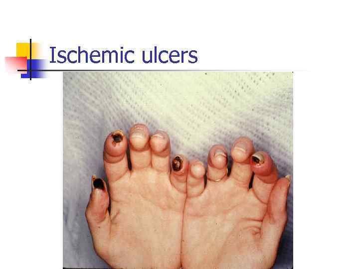 Ischemic ulcers 
