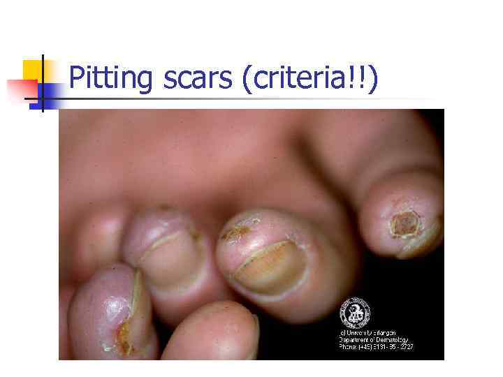 Pitting scars (criteria!!) 