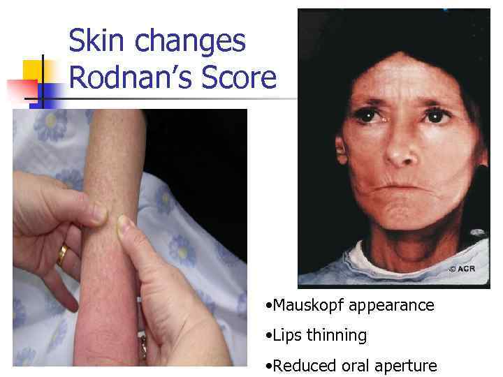 Skin changes Rodnan’s Score • Mauskopf appearance • Lips thinning • Reduced oral aperture