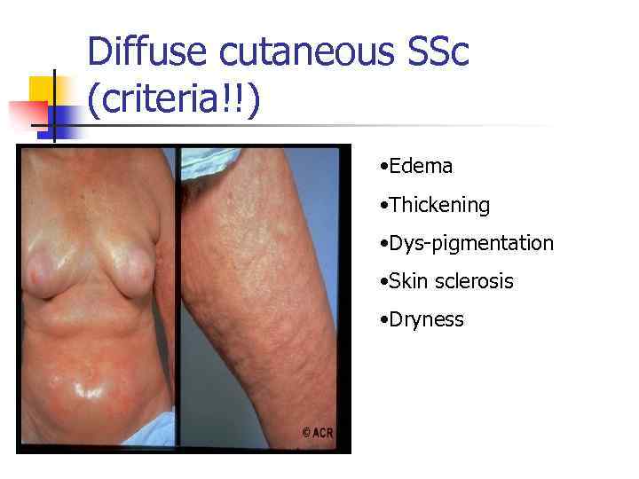 Diffuse cutaneous SSc (criteria!!) • Edema • Thickening • Dys-pigmentation • Skin sclerosis •