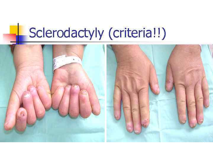 Sclerodactyly (criteria!!) 
