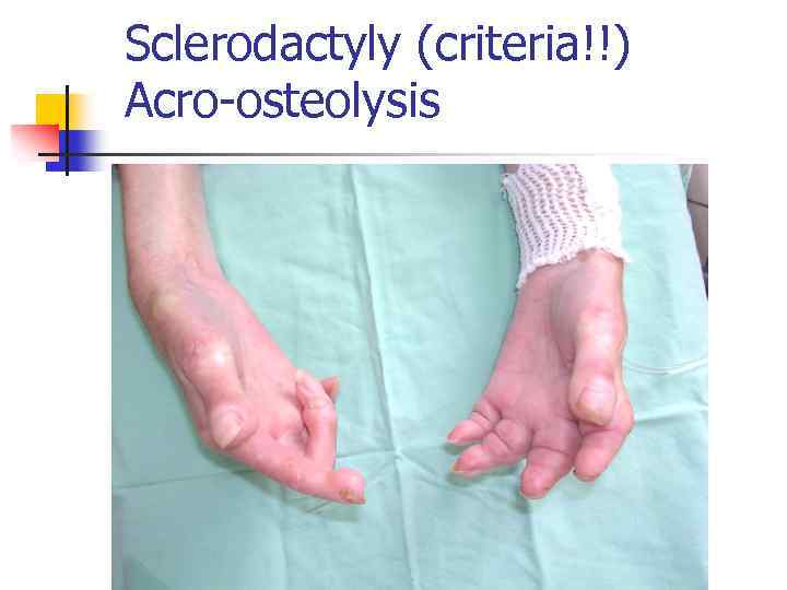 Sclerodactyly (criteria!!) Acro-osteolysis 