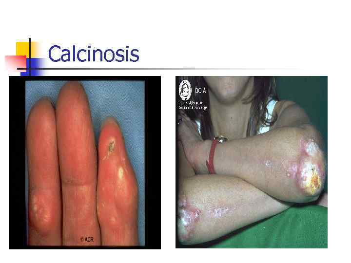 Calcinosis 