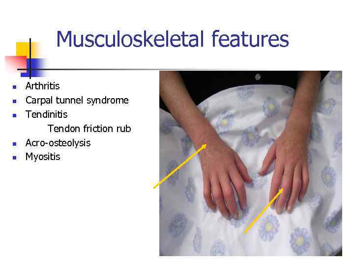 Musculoskeletal features n n n Arthritis Carpal tunnel syndrome Tendinitis Tendon friction rub Acro-osteolysis