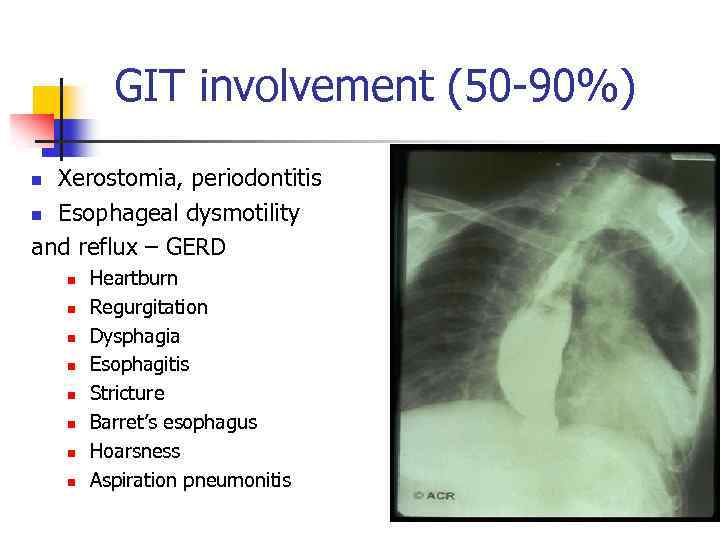 GIT involvement (50 -90%) Xerostomia, periodontitis n Esophageal dysmotility and reflux – GERD n