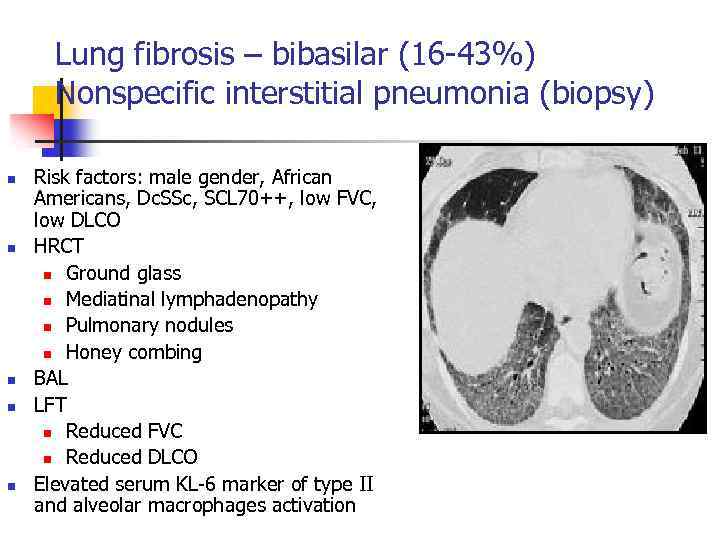 Lung fibrosis – bibasilar (16 -43%) Nonspecific interstitial pneumonia (biopsy) n n n Risk