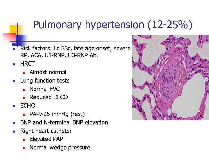 Pulmonary hypertension (12 -25%) n n n Risk factors: Lc SSc, late age onset,