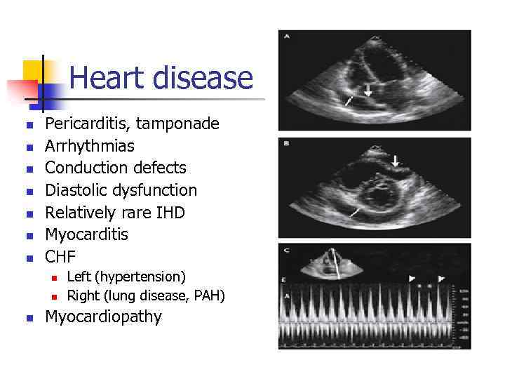 Heart disease n n n n Pericarditis, tamponade Arrhythmias Conduction defects Diastolic dysfunction Relatively