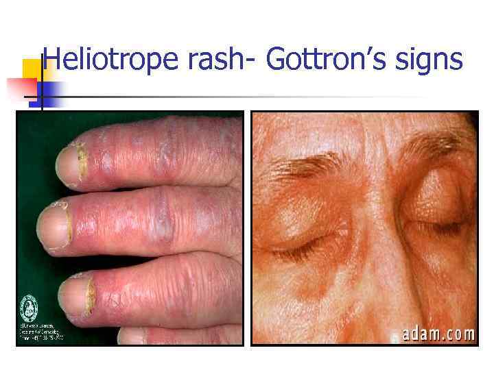 Heliotrope rash- Gottron’s signs 