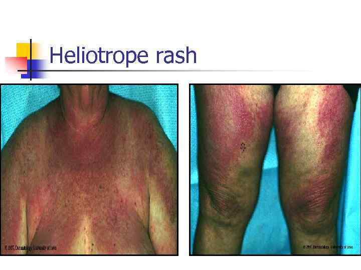 Heliotrope rash 